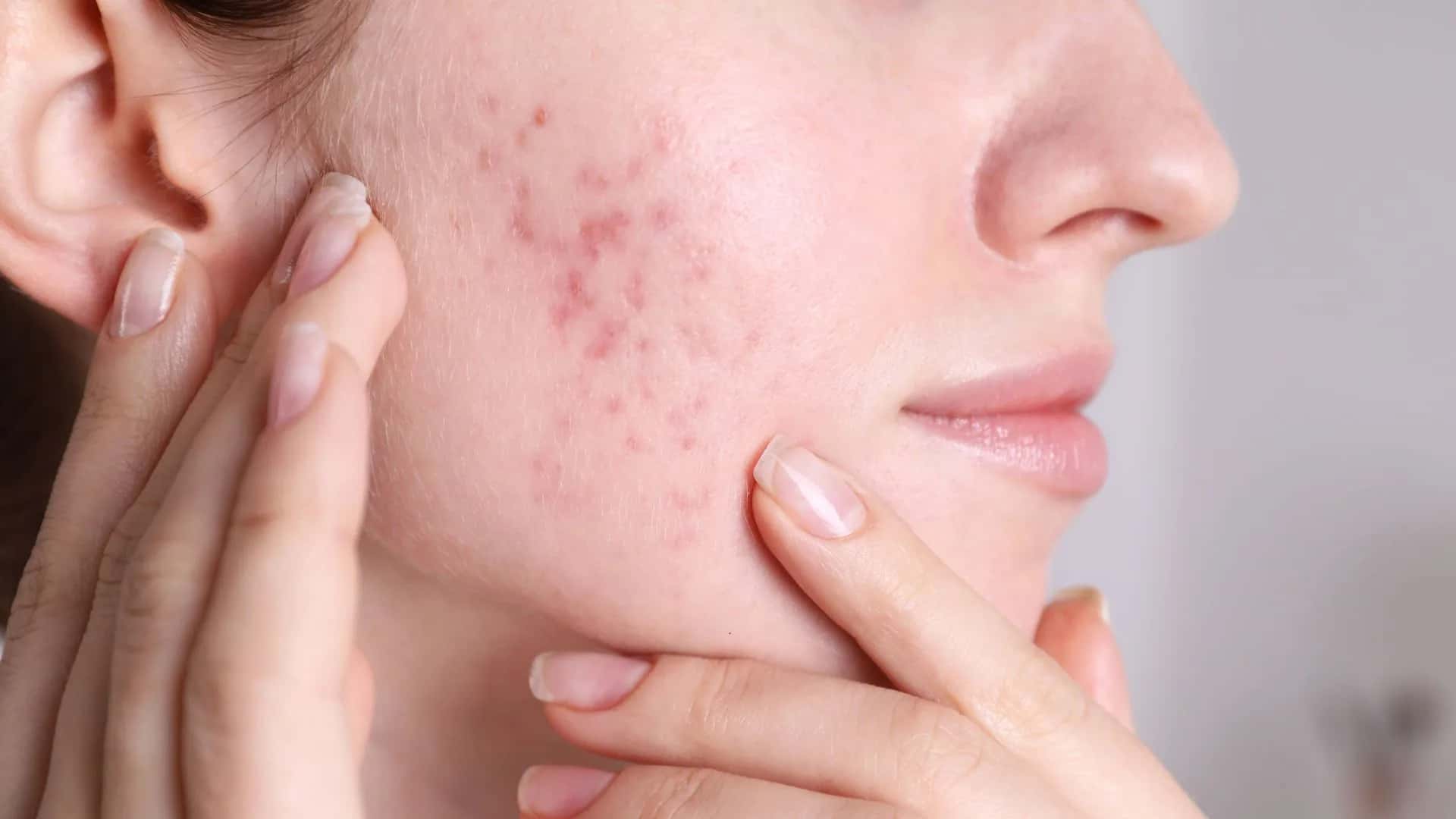 Top Remedies for Skin Imbalance Issues