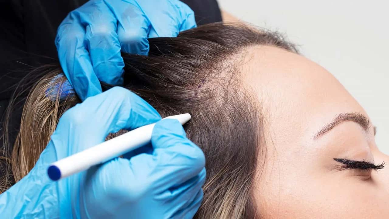 Transplante Capilar Feminino: Como Funciona, Indicações e Resultados