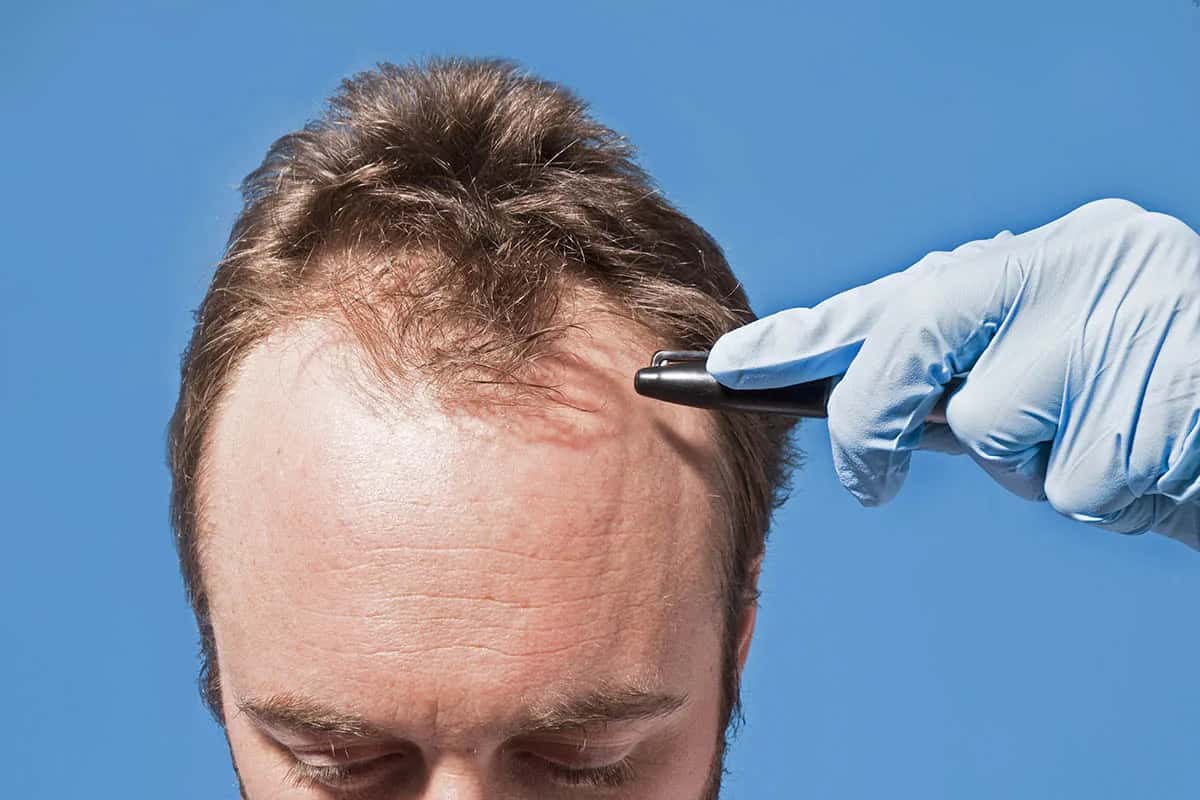 Transplante Capilar Sem Raspar o Cabelo: Como Funciona e Para Quem é Indicado