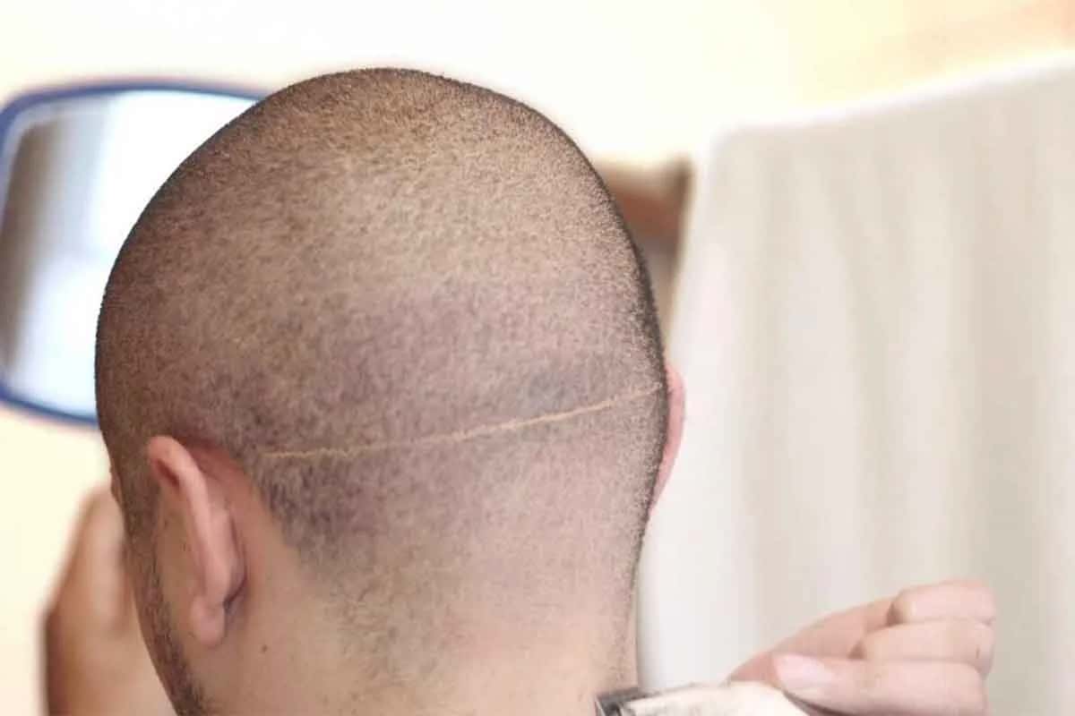 Tut eine Haartransplantation weh?
