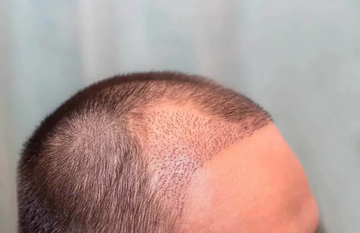 Unshaven Hair Transplant Turkey: Cost, Techniques, Recovery and Suitability
