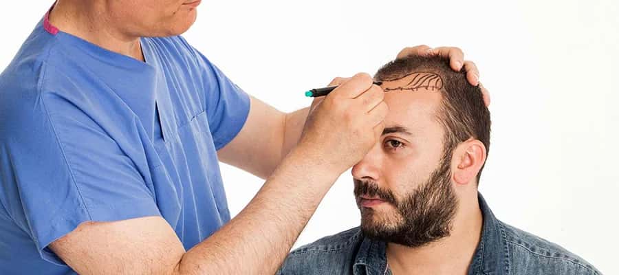 Vor- und Nachteile einer Haartransplantation im Überblick