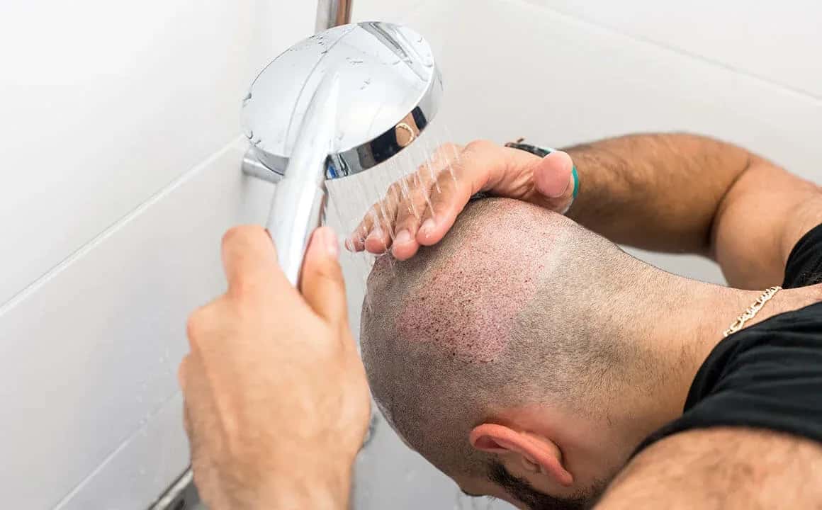 Washing Frequency Be After a Hair Transplant