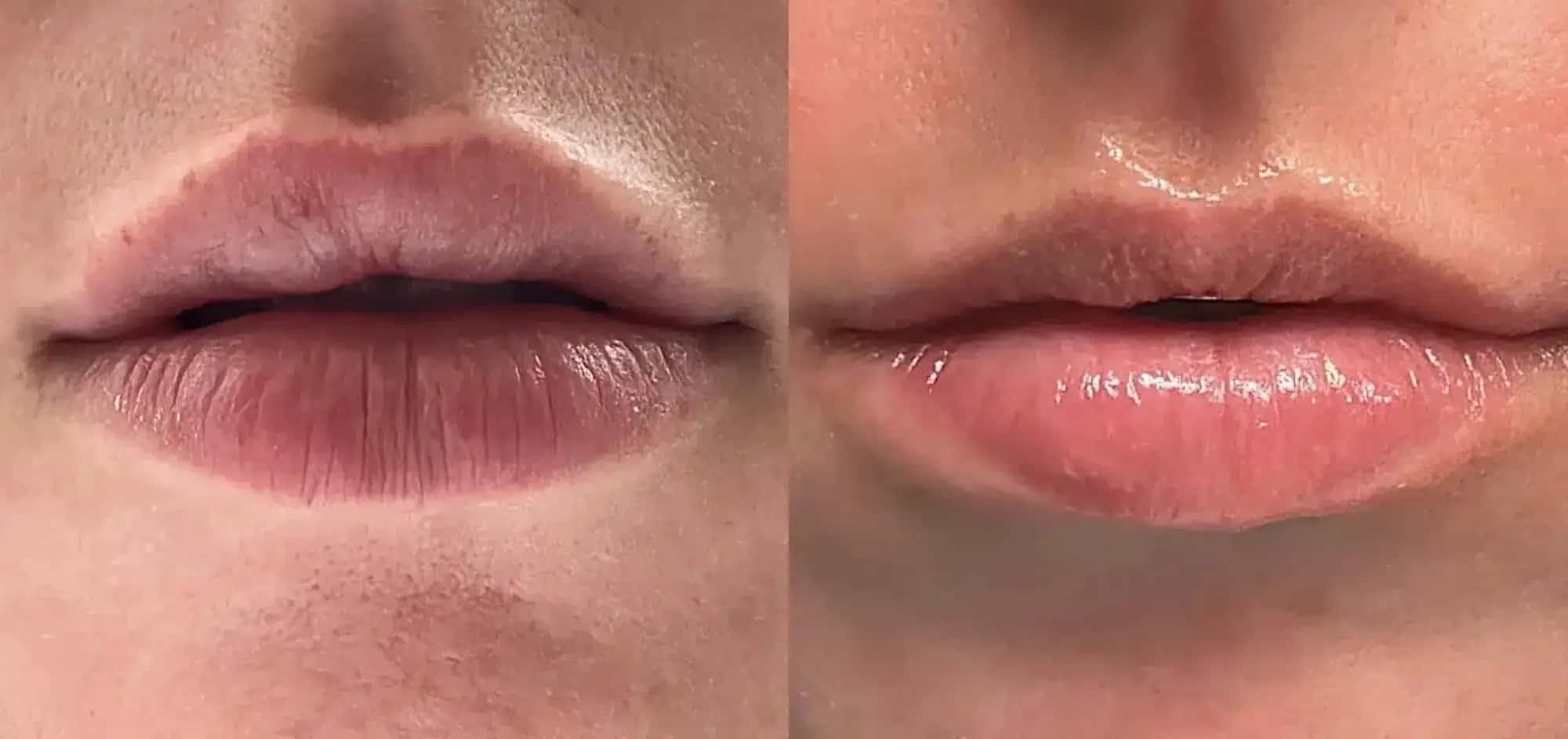 What Happens After Dissolving Lip Filler?