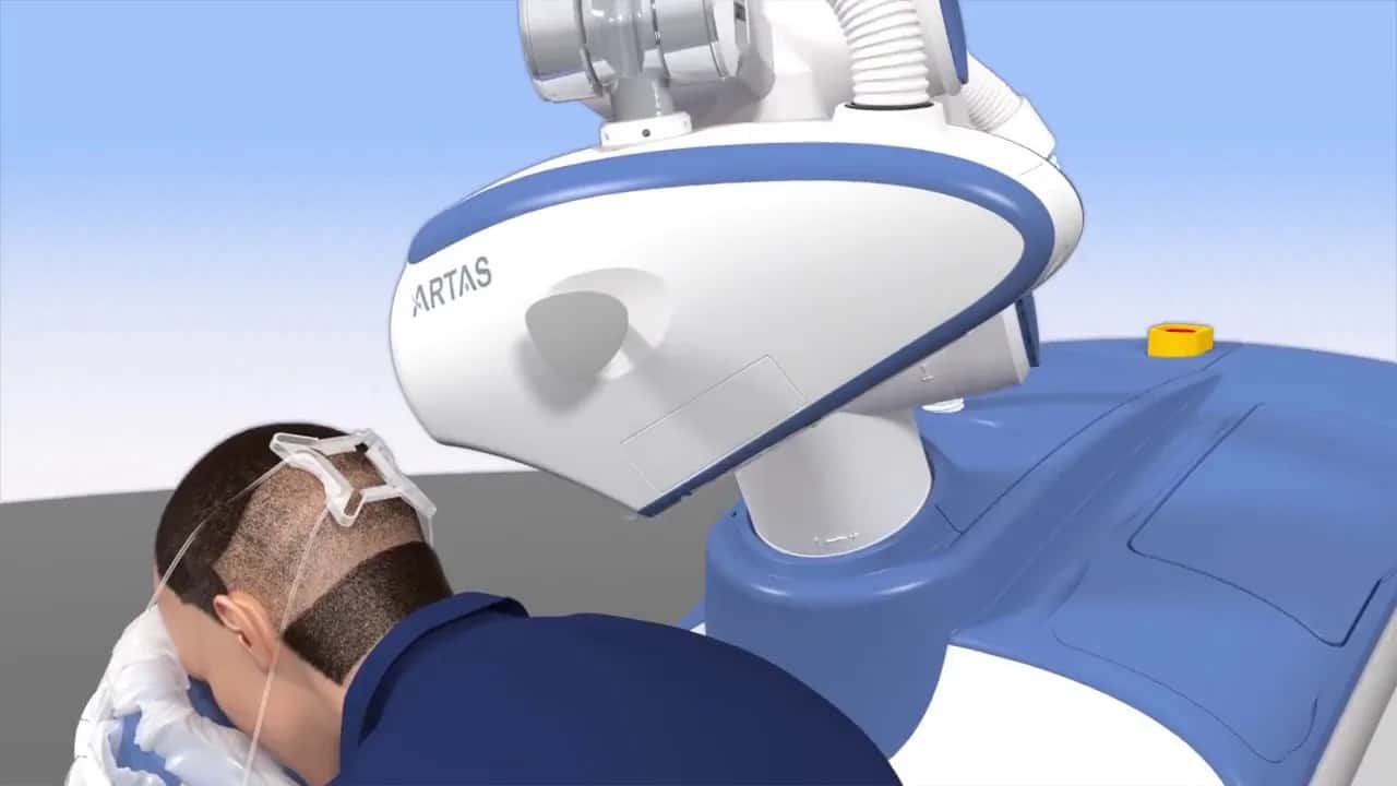 What Is ARTAS Hair Transplant?