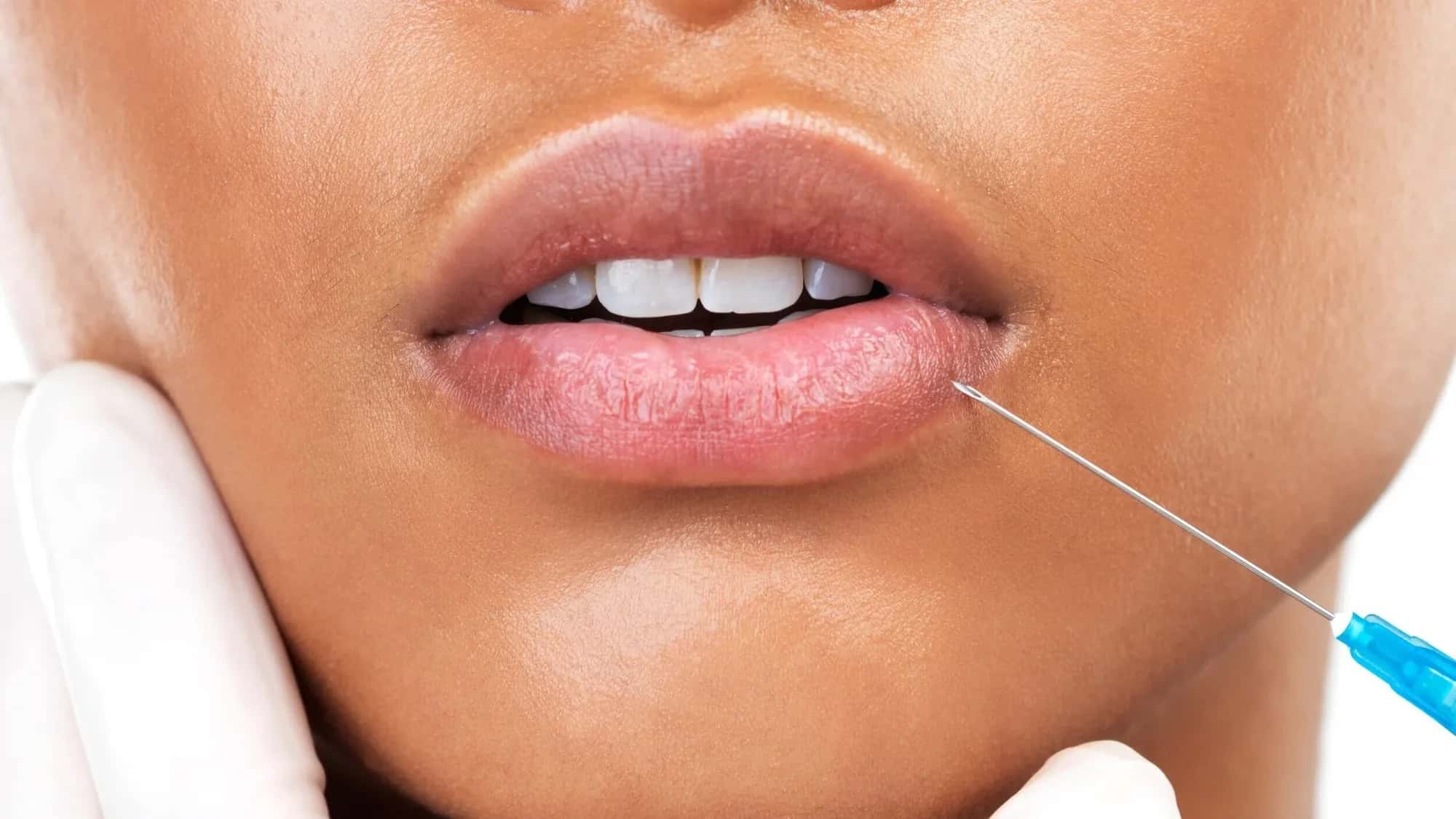 Why People Are Dissolving Their Fillers?