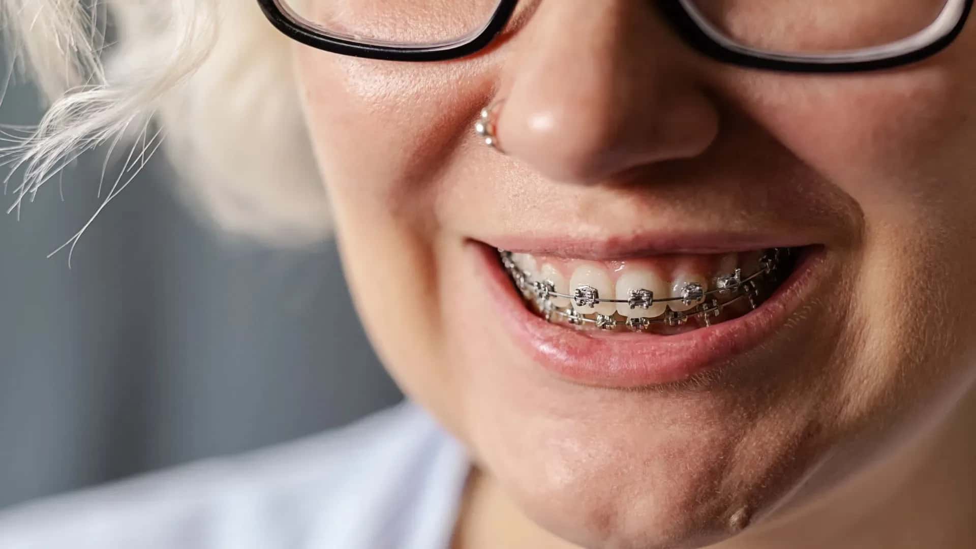 Wo bekommen Sie günstige Zahnspangen? Sparpläne
