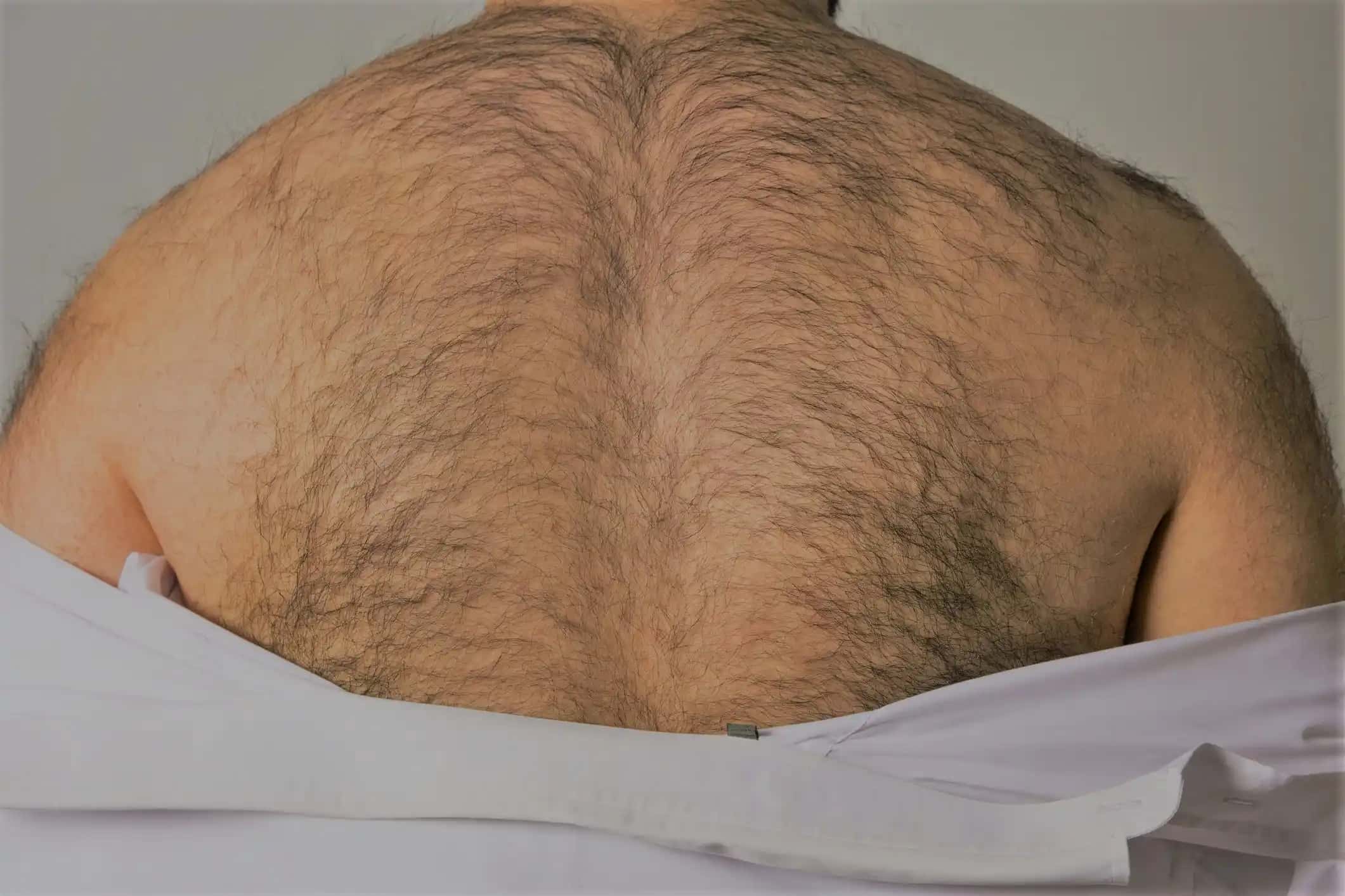 Hair Transplantation from Back Hair
