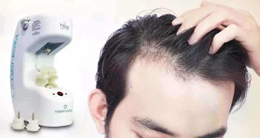 Otolog Mikro Greft Tedavisi (Regenera Activa) Nedir?