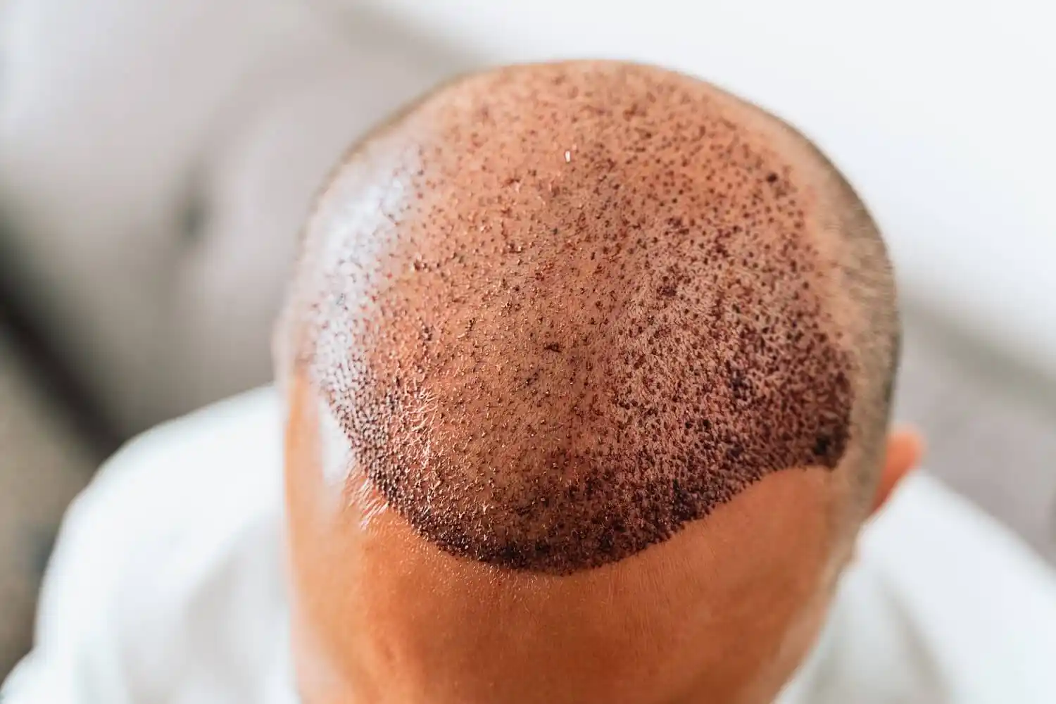 The First 10 Days After Hair Transplantation