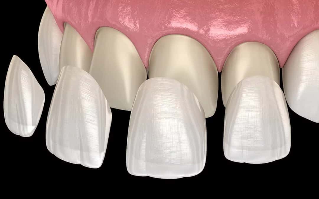 Top 10 Best Veneer Clinic in Turkey