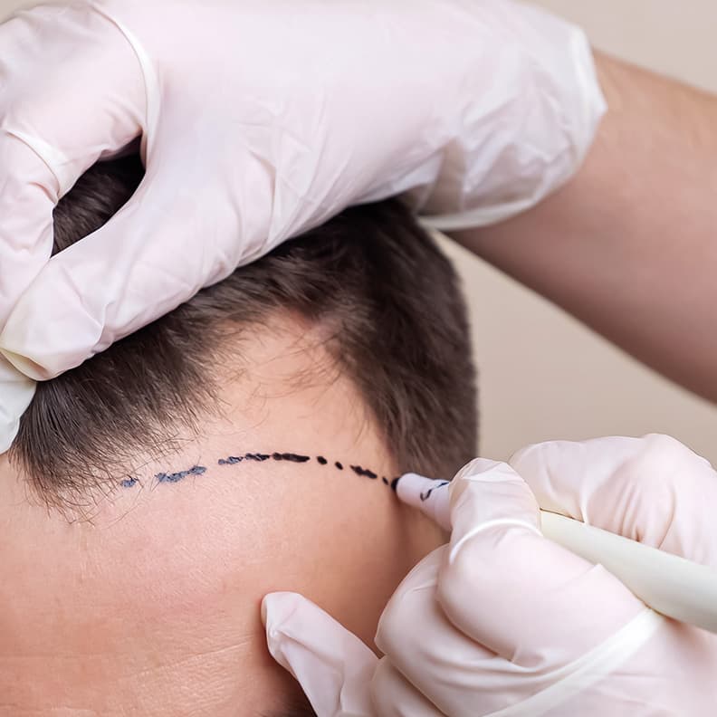 Hair Transplant