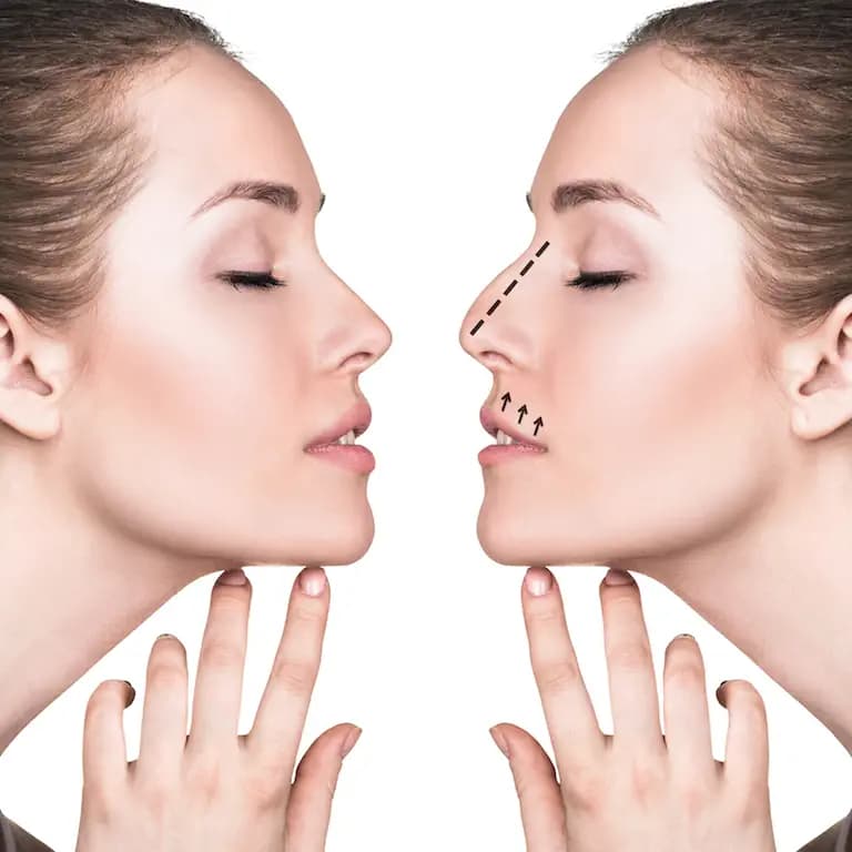 Rinoplastia