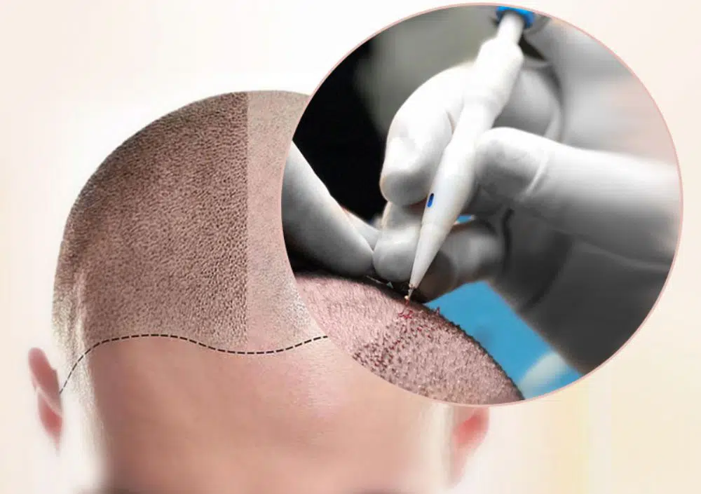Die 5 Besten Haartransplantationskliniken