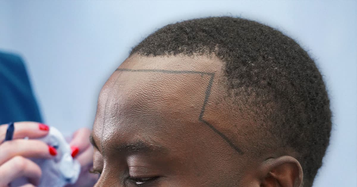 Top 5 Leading Afro Hair Transplant Clinics in Turkey
