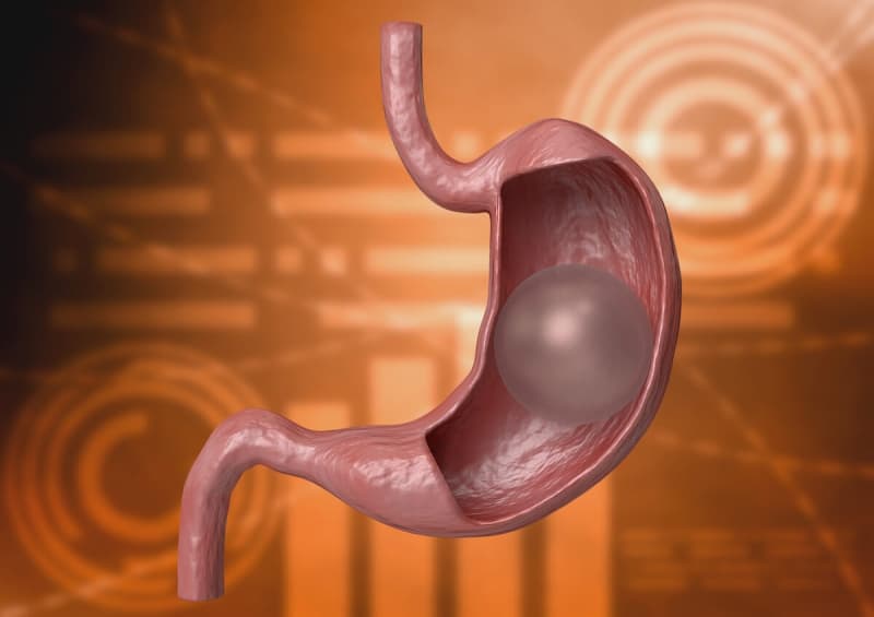Top 5 Gastric Balloon Clinics in USA