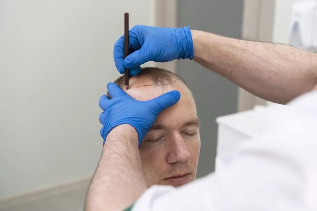 Top 5 Hair Transplant Clinic in France