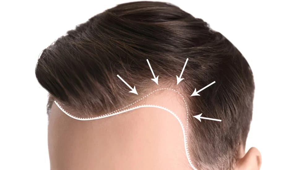 Top 5 Hair Transplant Clinic in Germany