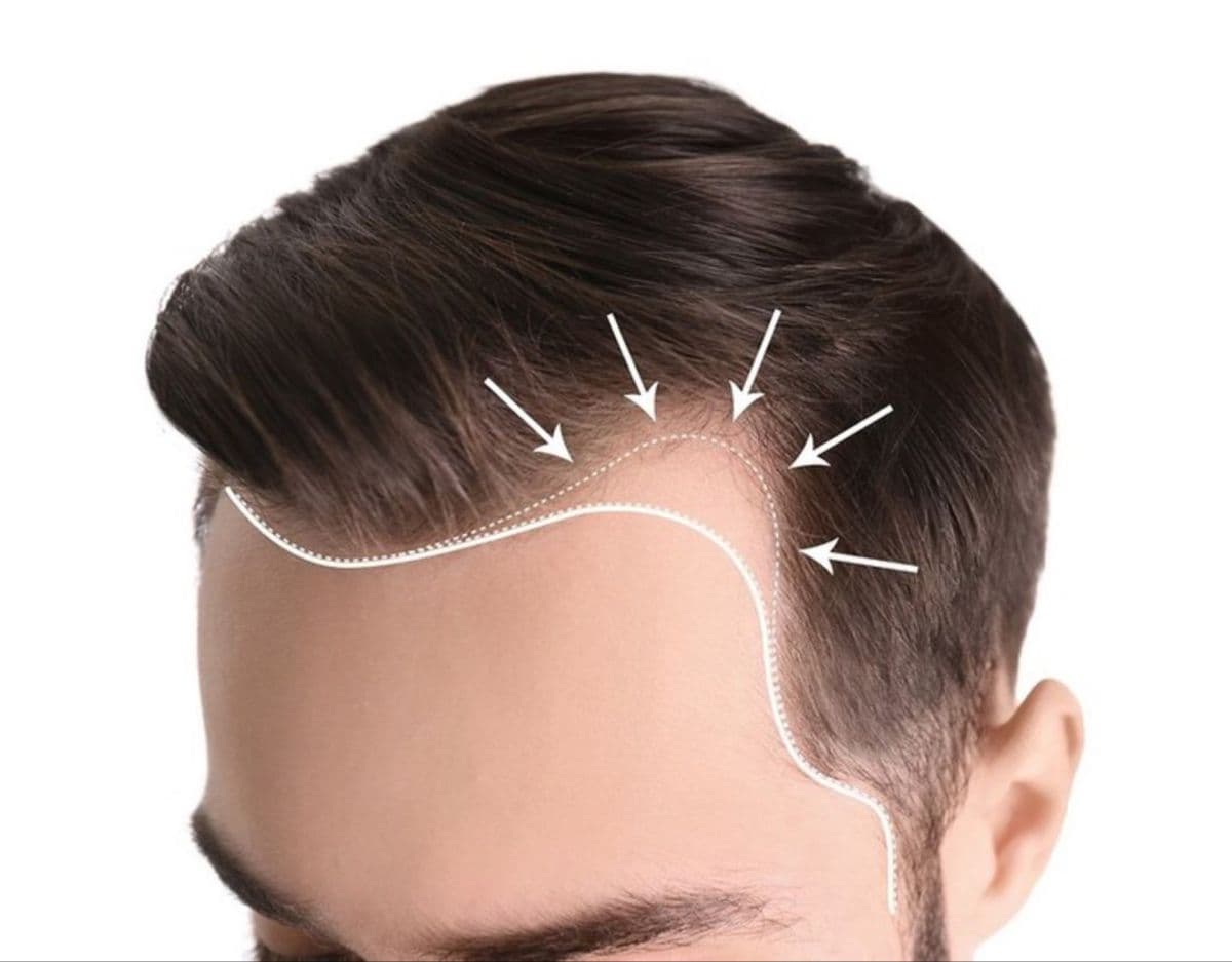 Top 5 Hair Transplant Clinics in Switzerland