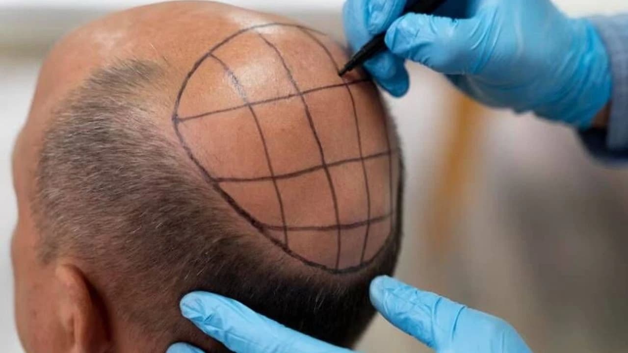 Top 5 Hair Transplant Clinic in Mexico