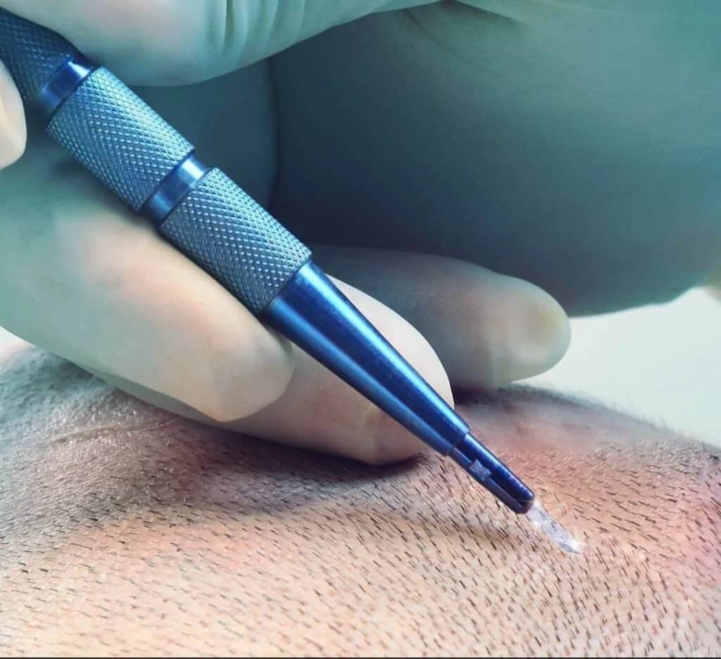 TOP 5 Hair Transplant Clinics in Miami