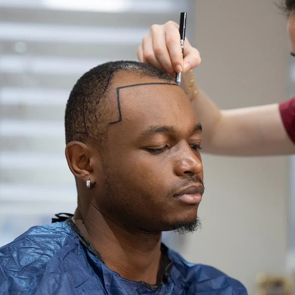 TOP 5 Unshaven Hair Transplant Clinics That Stand Out in Turkey