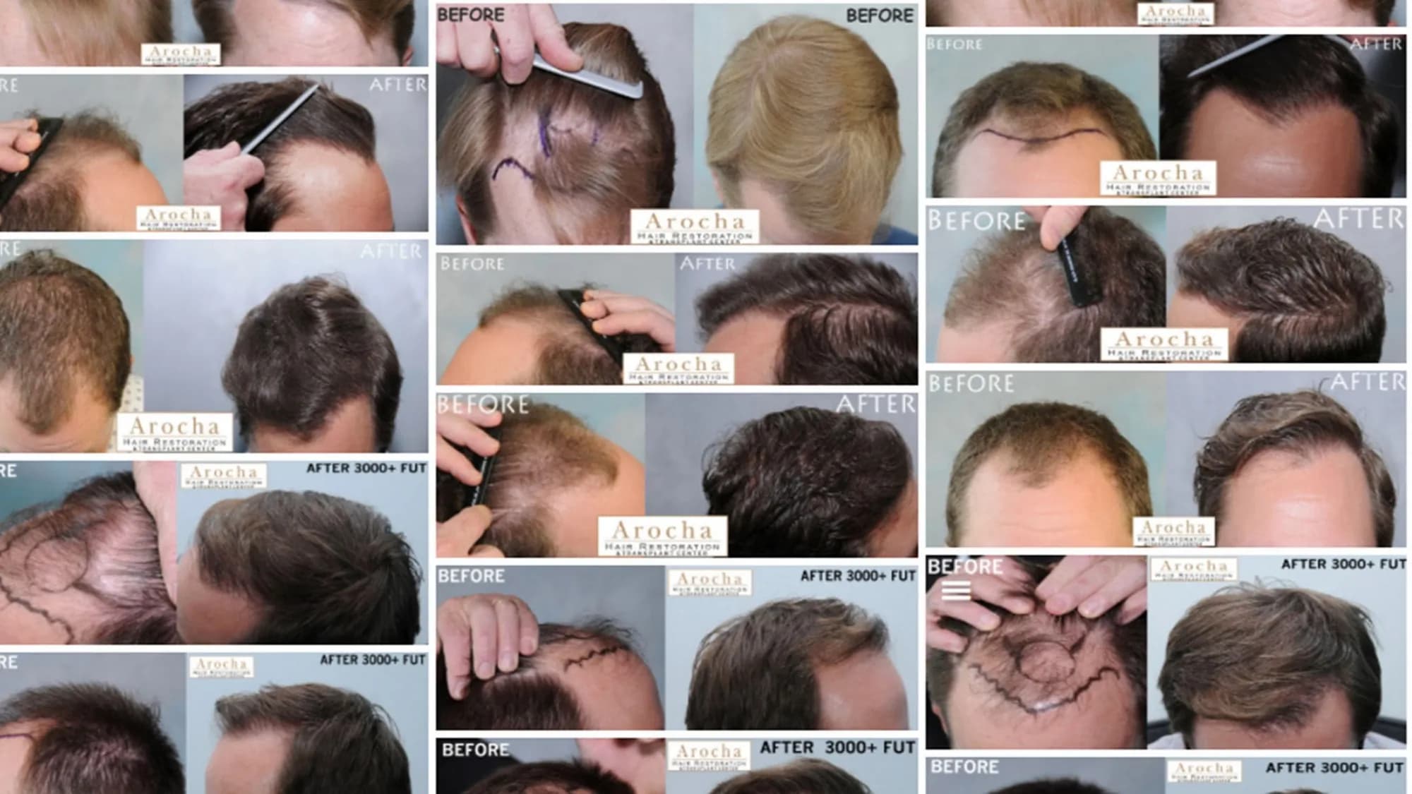 Arocha Hair Restoration