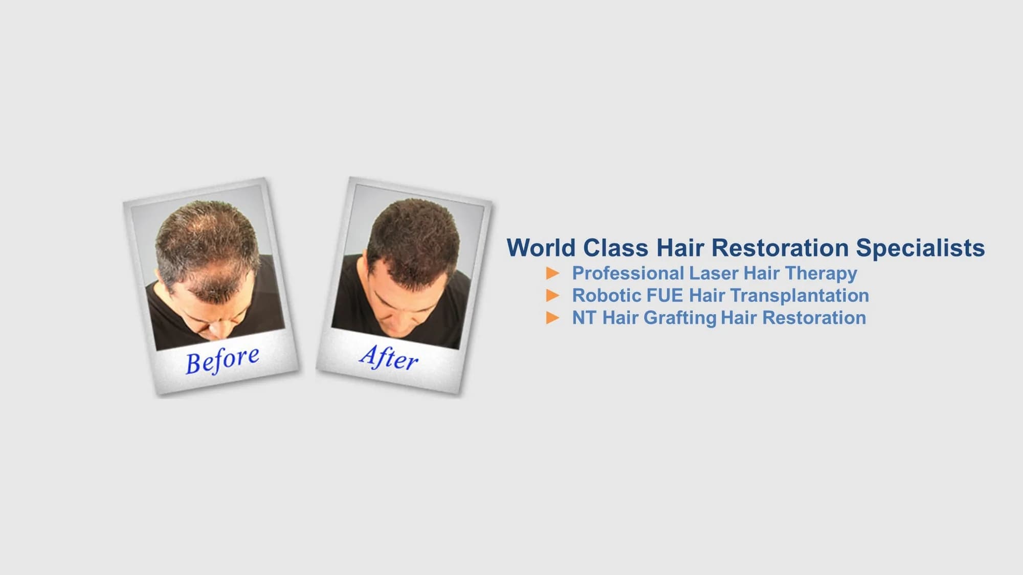 Sure Hair Transplants Scarborough