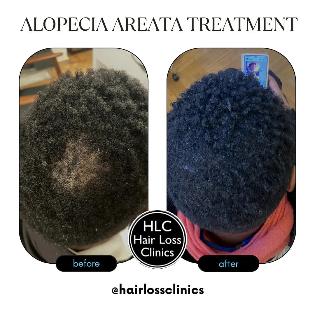 Liverpool Hair Loss Clinic