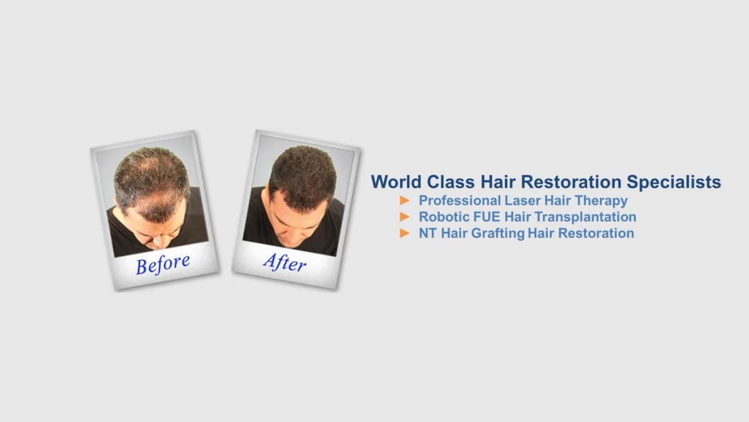 Sure Hair Transplants Toronto